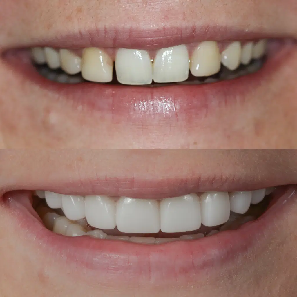 Before-After-87-Veneers