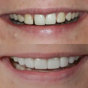 Before-After-87-Veneers