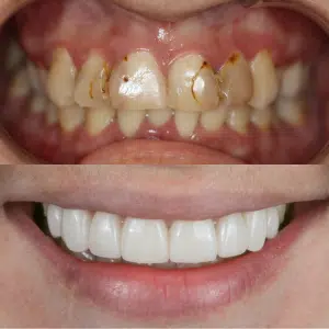 Before-After-88-Crowns