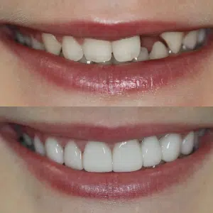 Before-After-90-Veneers