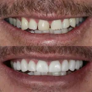 Before-After-91-Veneers